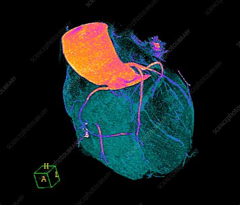 Normal Heart 3d Ct Scan Stock Image C0479229 Science Photo Library