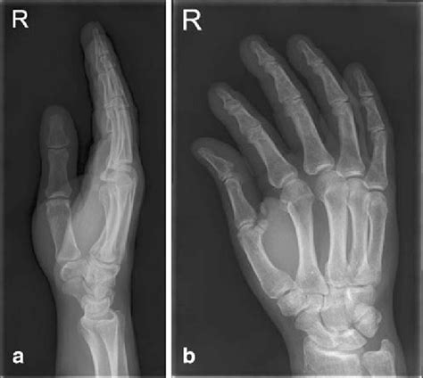 A Lateral And B Oblique Radiographs Of The Right Hand 8 Months After