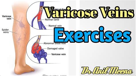 Varicose Vain Exercises Varicose Vein Treatment Varicose Vain Causes And Treatment In