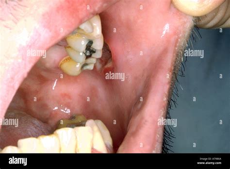 Mouth Ulcers Hiv Stock Photo 497770 Alamy