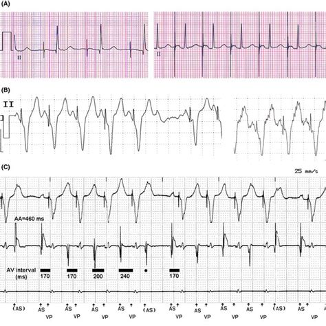 A Lead Ii Pacing In Aai Mode Atrial Pacingatrial Sensingpacing