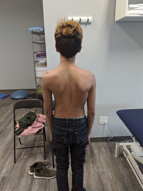 Back Pain: Scoliosis - Motion Science Physiotherapy Clinic