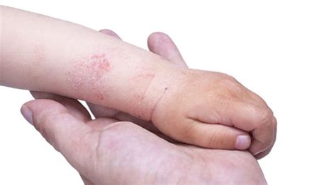 Dermatitis Atopik Penyebab Gejala Pengobatan Klikdokter