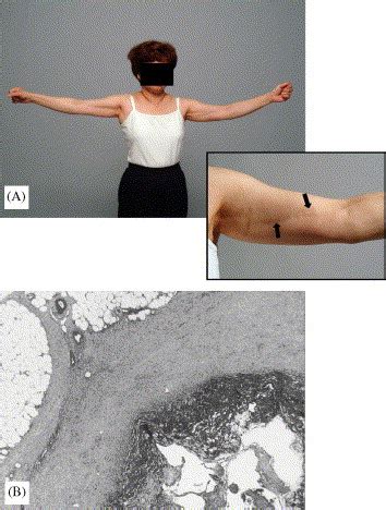 A Case Of Axillary Web Syndrome With Subcutaneous Nodules Following