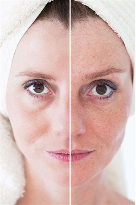 Age Spots Cause Prevention And Treatment Skincare Products Facial