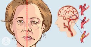 Apa Itu Stroke Hemoragik Penyebab Dan Cara Mengobatinya