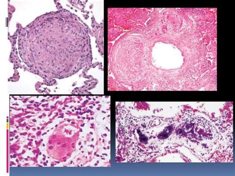 Interstitial Lung Diseases Andvpathology Of Lung In Aids