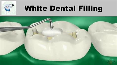 Composite Dental Filling Procedure Dental Clinic
