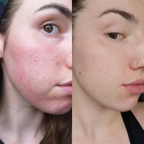 Derma Rolling Before And After Rejuviss