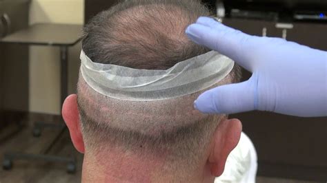 Fut Hair Transplant Donor Scar By Dr Diep In California