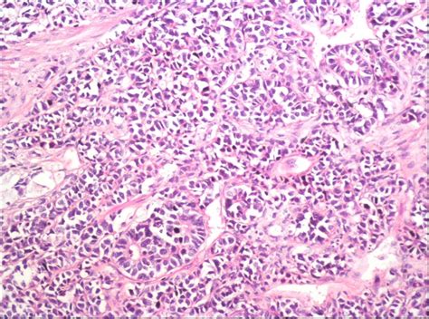 Pure Small Cell Carcinoma Of Prostate In A Patient Presenting With