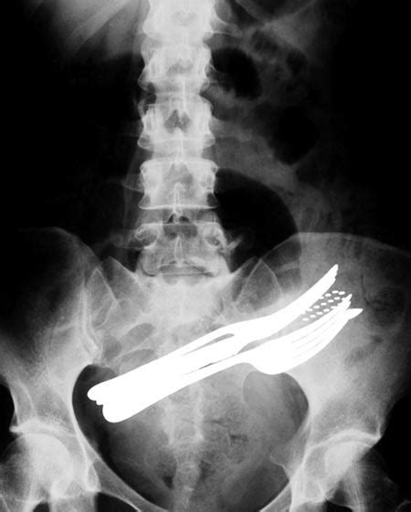 Järkyttäviä löytöjä ihmisten takapuolesta röntgenkuvat vetävät