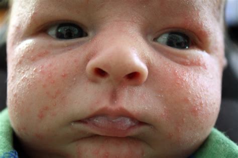Baby Acne Cure And Treatment June 2015