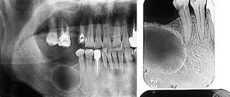 Jaw Tumors And Cysts Symptoms And Causes Comhts