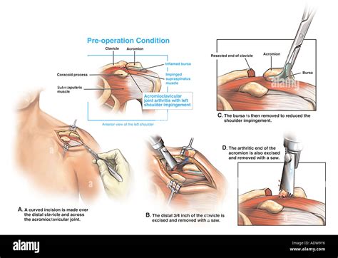 Articulación Acromioclavicular Artritis Y Tratamiento Con La Reparación