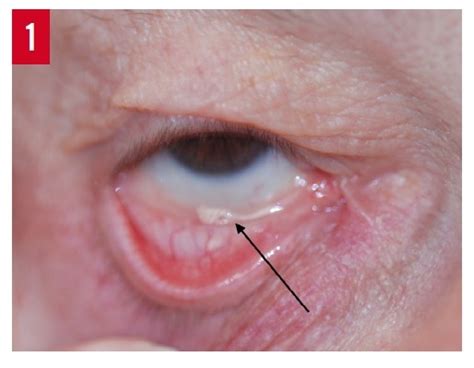 Ectropion Classification Diagnosis And Management Consultant360