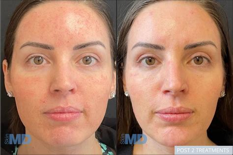 Morpheus8 Before And After Photos Skin Md