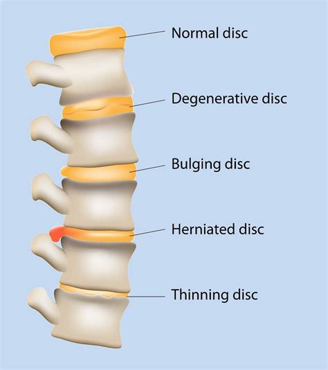 Degenerative Disc Disease Kalra Brain And Spine