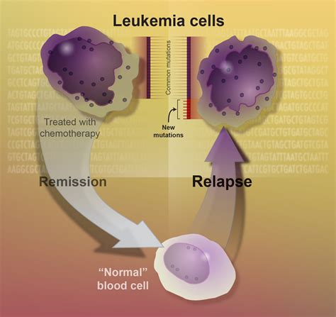 Treatment For Leukemia Cells General Center