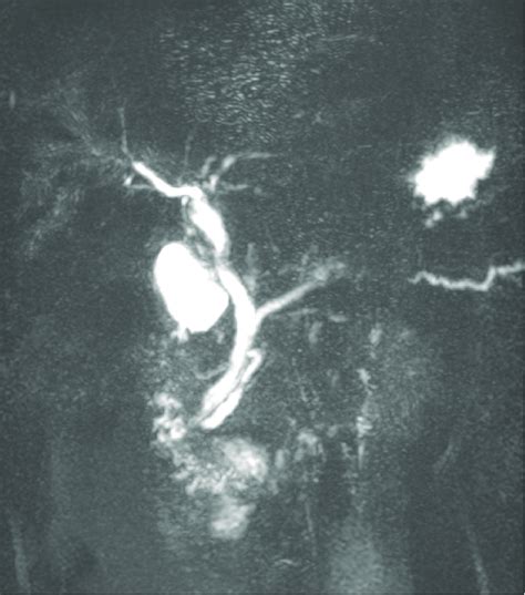 Mrcp Image Post Ercp Showing Normal Diameter Cbd With Disappearance
