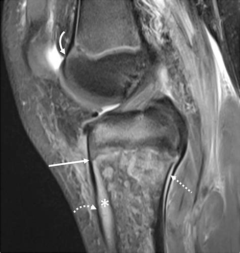 A 9 Year Old Girl With Proximal Tibial Osteomyelitis Sagittal