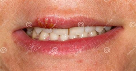 Oral Herpes Simplex Virus Infection Stock Image Image Of Painful Herpes 179476523