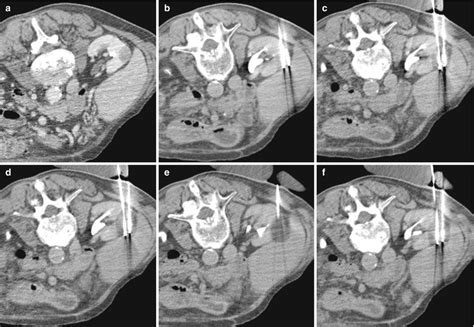 Ablation And Cryoablation For Renal Cell Carcinoma Radiology Key