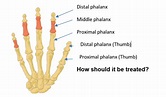 Hand Therapy - Phalangeal fractures of the fingers or thumb | Hull ...