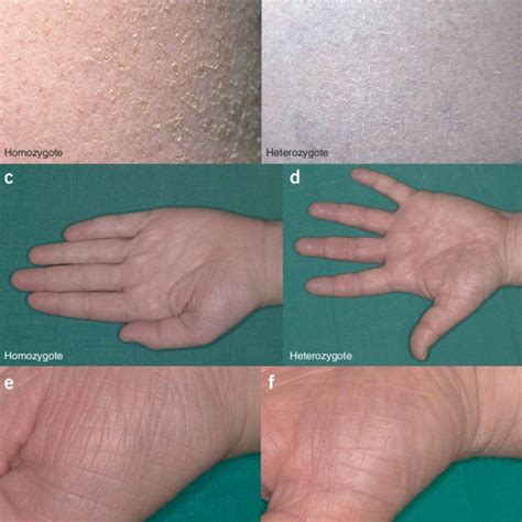 Clinical Appearance Of Ichthyosis Vulgaris Ace Full Presentation