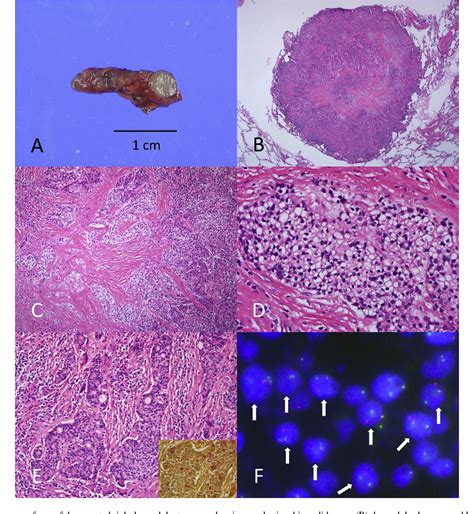 Figure 1 From Primary Pulmonary Hyalinising Clear Cell Carcinoma With