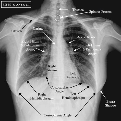 Normal Chest Xray Labeled