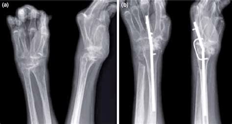 Left Wrist Radiograph Of Patient 4 A Preoperative Radiograph B