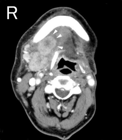 Carcinoma Ex Pleomorphic Adenoma Of The Submandibular Gland Report Of A Case With An Unusual