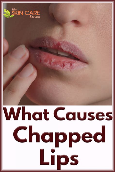 What Causes Chapped Lips Sensitive Skin Care Healthy Lips Dry Skin Care