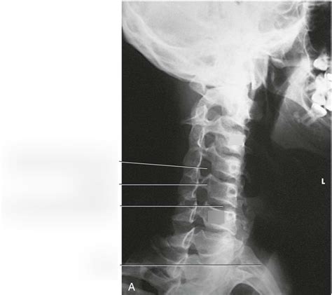 Cervical Spine X Ray Anatomy Anatomical Charts And Posters