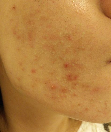 Acne Closed Comedones Clogged Pores Hell Skincareaddiction