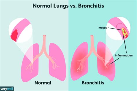 Bronchitis Symptoms Signs And Complications