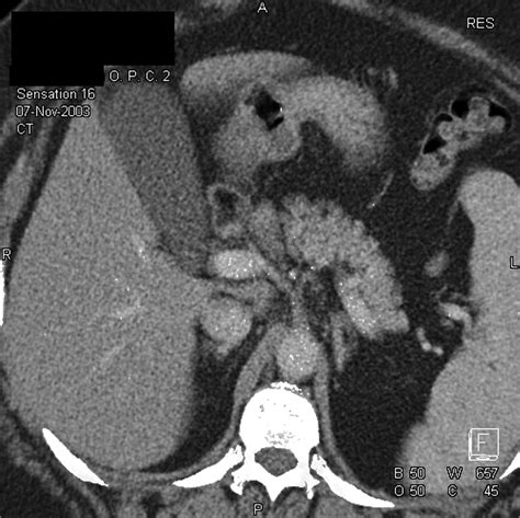 Ct Of The Gallbladder Spectrum Of Disease Ajr