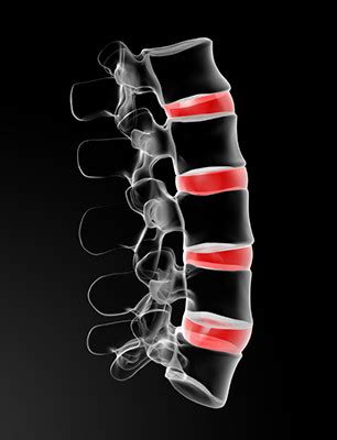 A herniated disc (also called bulged, slipped or ruptured) is a fragment of the disc nucleus that is pushed out of the annulus, into the spinal discs that become herniated usually are in an early stage of degeneration. Car Accident Herniated Disk Surgery | St. Louis Car Accident Lawyers
