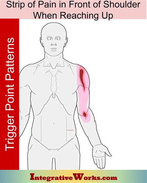 Superficial Strip Of Shoulder Pain When Reaching Up Integrative Works