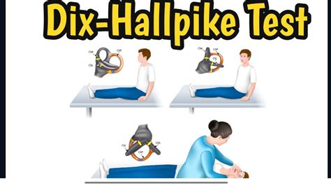 Dix Hallpike Test Epley Maneuver Vs Dix Hallpike Test Diagnosis Of
