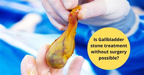 In humans the loss of the gallbladder is usually easily tolerated. Is gallbladder stone treatment without surgery possible ...