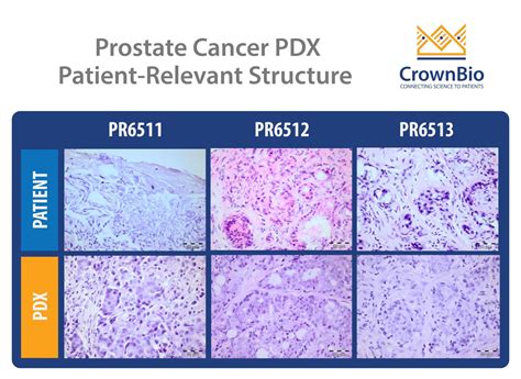 Prostate Cancer Patient Derived Xenograft Pdx Models
