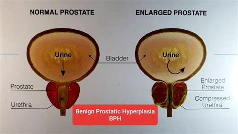 Bph Prostatomegly Prostatic Enlargement Benign Prostatic Hyperplasia Part I In Dr M K