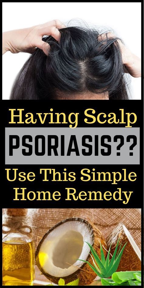 Home Remedies To Treat Scalp Psoriasis Check More At