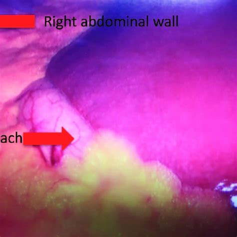 The Stomach On The Right Side Of The Abdomen Download Scientific Diagram