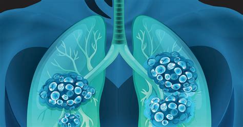 Understanding Your Lung Cancer Risk