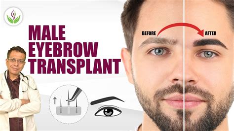 Male Eyebrow Transplant Procedure In Delhi Care