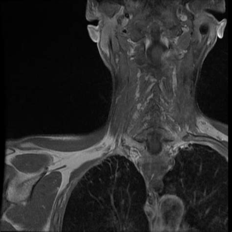 Pancoast Tumour Treated With Radiotherapy Radiology Case