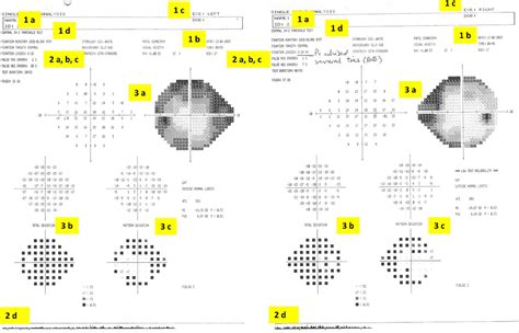 Visual Field Test Visual Field Test Results Interpretation